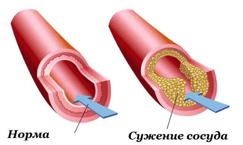 Сужение сосудов